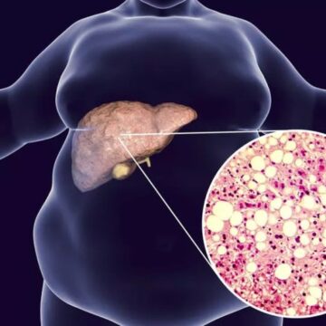 Ciencia: Cambiarán el nombre a la enfermedad del hígado graso