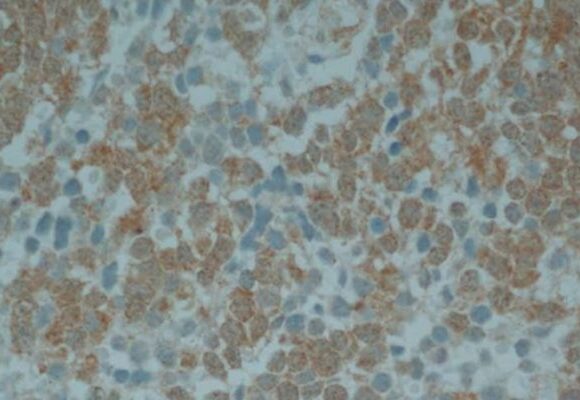 cancer infantil prueban con éxito una vacuna terapéutica para tratar un cáncer infantil agresivo