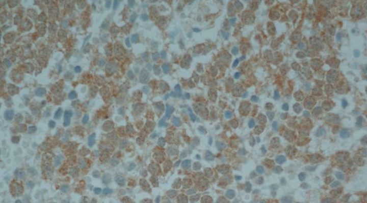 cancer infantil prueban con éxito una vacuna terapéutica para tratar un cáncer infantil agresivo